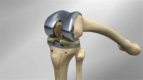 Vanguard® ID Total Knee Surgical Technique Animation