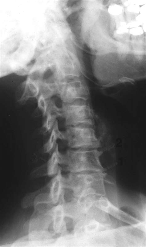 Cervical Spondylosis. Causes, symptoms, treatment Cervical Spondylosis