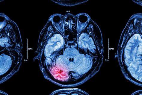 Latest Guidelines For Brain Death - The Virginia Trial Firm