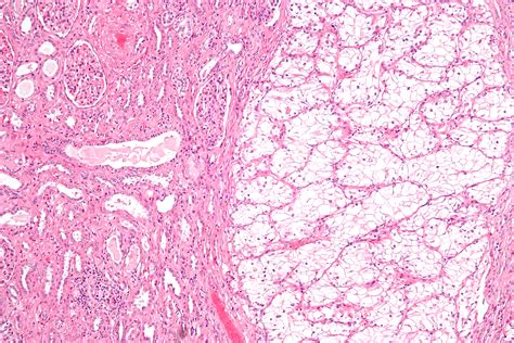 File:Clear cell renal cell carcinoma intermed mag.jpg