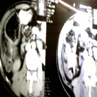 CT scan showing empty right iliac fossa with gross thickening of wall... | Download Scientific ...