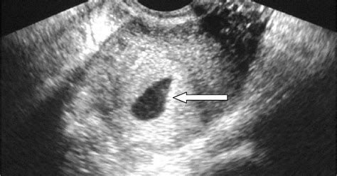 Me, my family and my career: First Trimester Obstetrical Ultrasound Report