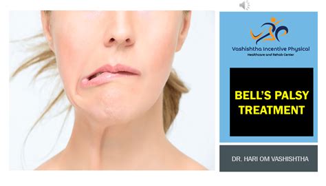 Bells-palsy-Treatment by Dr. Hari Om vashishtha | BEST PHYSIOTHERAPY REHAB CENTER IN GURGAON