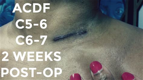 ACDF C5-6 C6-7 Two Weeks Post-op - YouTube