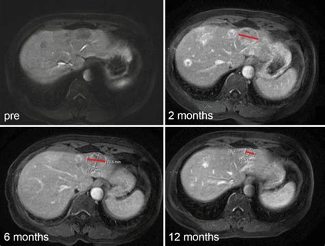 Fig. 4.5, [Axial post-contrast MRI before and...]. - Diseases of the ...