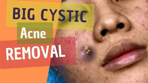 Big Cystic Acne and Blackheads Extraction - YouTube