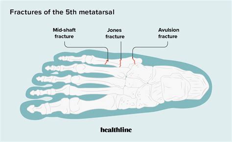 Head Of Metatarsals