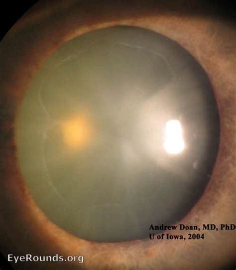 Atlas Entry - Pseudoexfoliation glaucoma