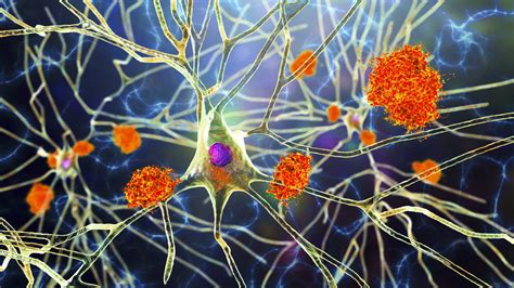 Alzheimer's Disease Progression Slowed Down by Microglia Activation