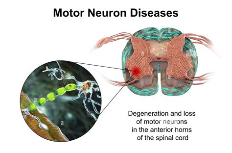 Belüftung Beunruhigt Butter motor neuron disease Siehe Insekten Ich habe mich verlaufen Schwanken