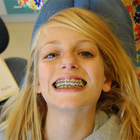 Color Braces: See Why Kids Love Their Fun Colorful Smiles