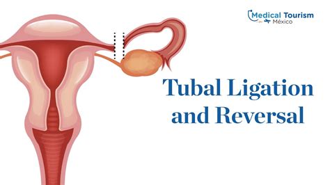 Tubal ligation and Tubal reversal - Medical Tourism Mexico - Health Reporter