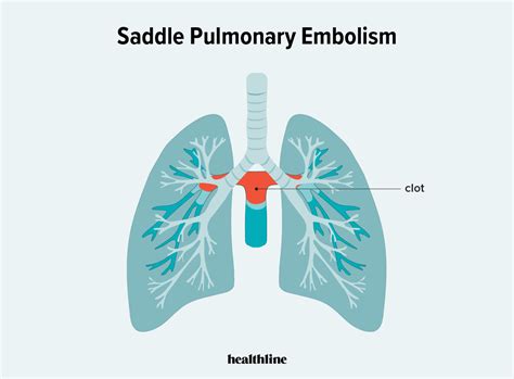 Saddle Pulmonary Embolism Diagram