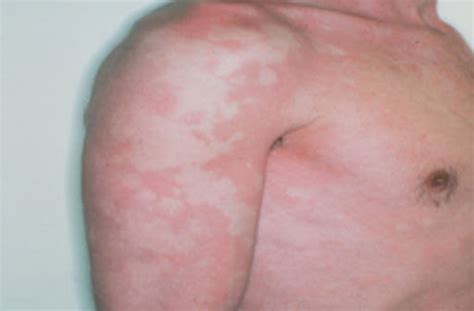 CARCINOID SYNDROME – Dermatology Conditions and Treatments