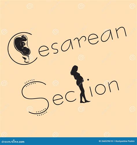 Cesarean Section Vector Illustration | CartoonDealer.com #266529618