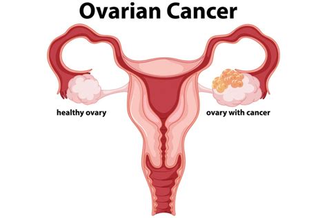 Screening Ovarian Cancer – Lifeline Laboratory