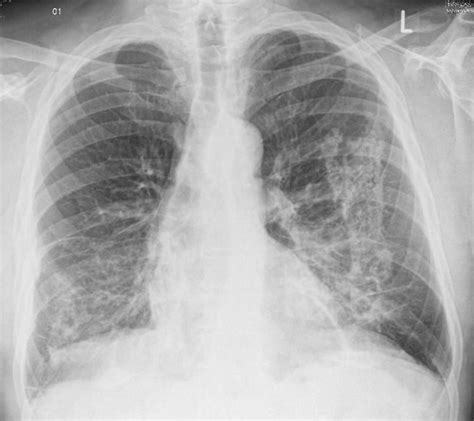 Pin on Interstitial lung diseases