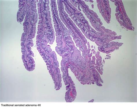 Pathology Outlines - Traditional serrated adenoma