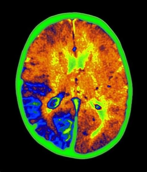 Coloured MRI brain scan of Sturge-Weber syndrome Our beautiful Wall Art ...