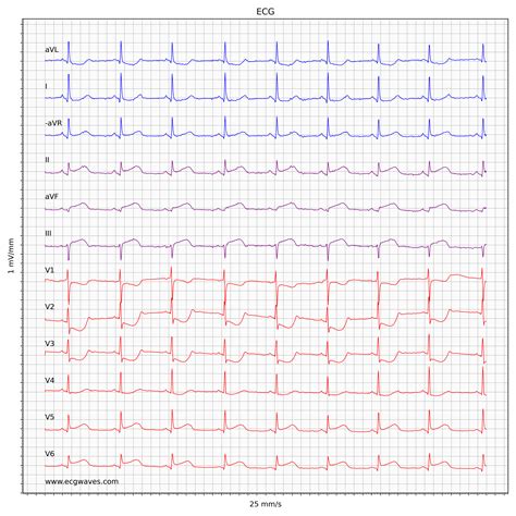 ECG Test – Quiz 5 - Mixed Conditions – Cardiovascular Education