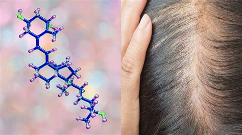 Researchers Reveal A Connection Between Vitamin D Deficiency And Hair Loss