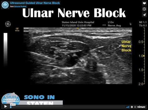 Ultrasound Guided Forearm Ulnar Nerve Block — SIUH Emergency Residency Program