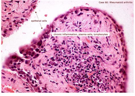 Rheumatoid Arthritis: Histology of RA