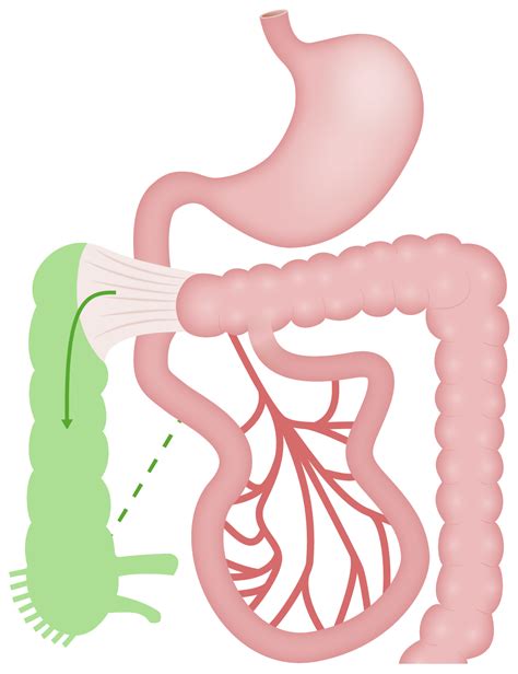 Intestinal Malrotation And Midgut Volvulus Image