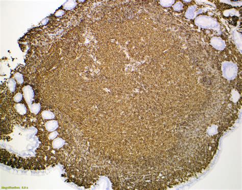 Pathology Outlines - Follicular lymphoma-duodenal type