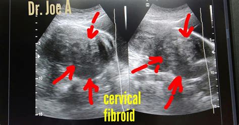 Ultrasound imaging: Cervical fibroid- a large one