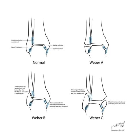 Weber fracture classification | Radiology Case | Radiopaedia.org ...