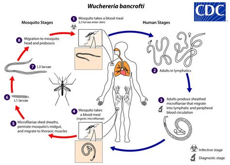 Wuchereria bancrofti infection, life cycle, symptoms, diagnosis & treatment