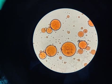 [4000x3000pix] Found two large plain in color lumps in patients pulmonary pleurae fluid. Smashed ...