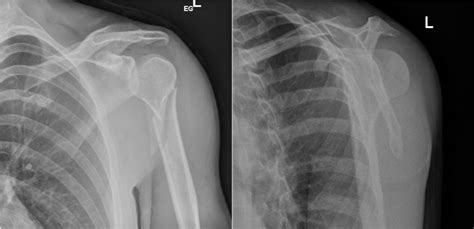 Missed posterior shoulder fracture dislocations: a new protocol from a London major trauma ...