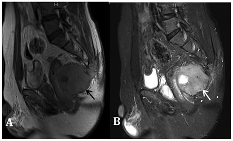 Treatment for giant cell tumor of the spine metastasizing to the lung ...