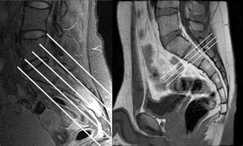 MRI Pelvis Piriformis WO MSK Protocol | OHSU