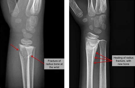 Buckle Fracture - Raleigh Hand Surgery — Joseph J. Schreiber, MD