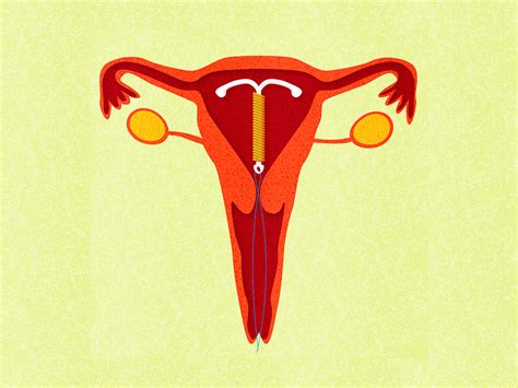 When Is It OK to Get Your IUD Removed? | SELF