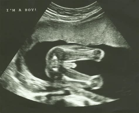 20 Week Anatomy Ultrasound