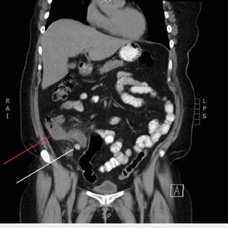 CT scan of the abdomen and pelvis with oral contrast (axial slice ...