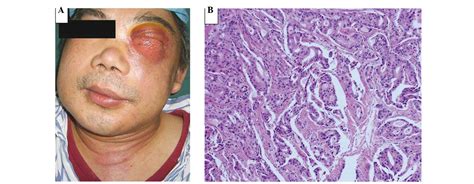 Differential diagnosis of a carcinoma of the maxillary sinus that resembles a sparganum ...