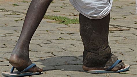 Welcome To Ladun Liadi's Blog: Sad! Elephantiasis Returns To Gombe State