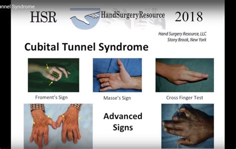 Cubital Tunnel Syndrome — OrthopaedicPrinciples.com