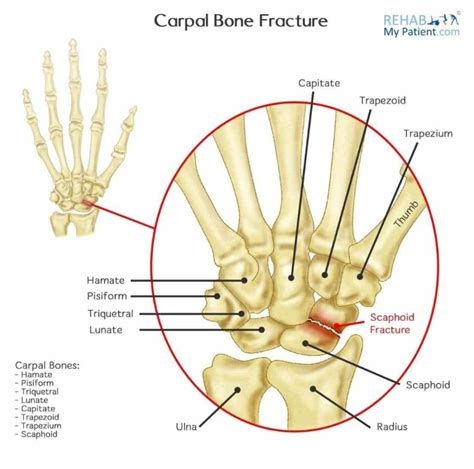 carpal ir Carpal Bones para carpal bone fractures over % of involve the scaphoid; second most ...