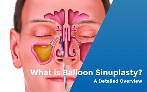 Balloon Sinuplasty | Sinus Procedure - Sinus Relief Center