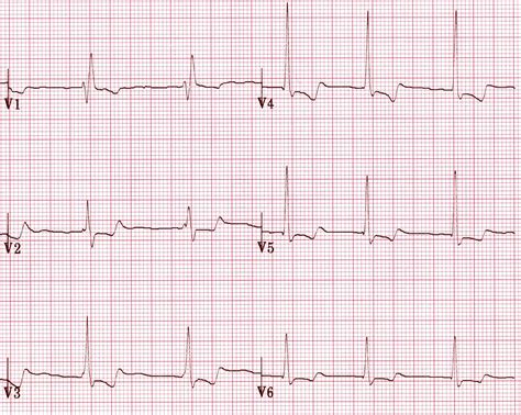 U Wave basic ECG patterns | Emergency medicine, Medical education, Education blog