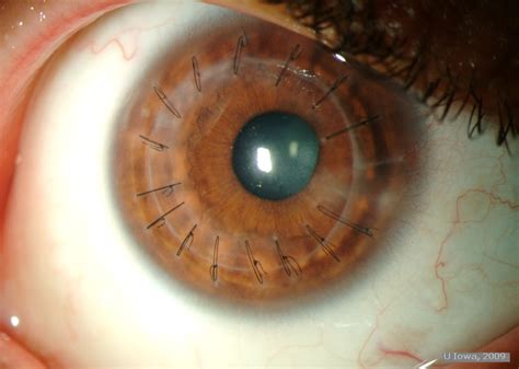 Keratoconus Surgical Options. EyeRounds.org - Ophthalmology - The University of Iowa