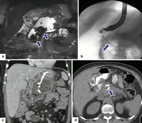 Pancreatic Pseudocyst | Radiology Key