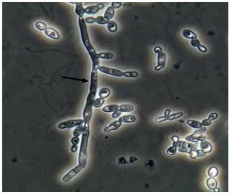 JoF | Free Full-Text | Urine Sediment Findings and the Immune Response to Pathologies in Fungal ...