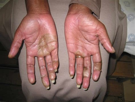 Peeling skin syndrome causes, types, symptoms, diagnosis & treatment